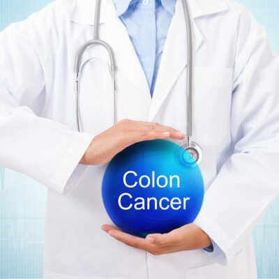 A Comprehensive Guide on Colon Cancer