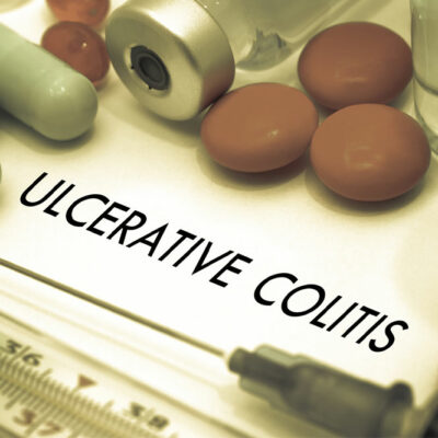 Top 4 Natural Treatments for Ulcerative Colitis