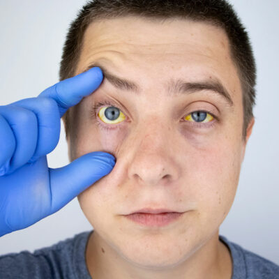 5 Myths About Hepatitis C